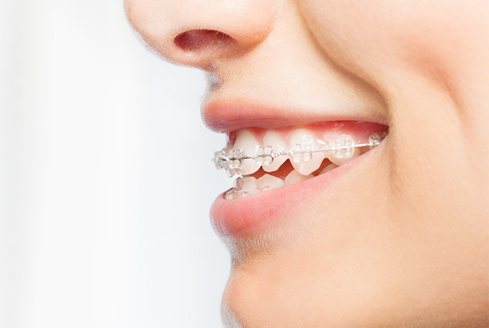 Fixed Braces Slide 2