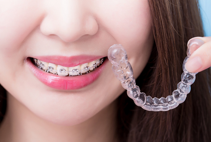 Fixed Braces