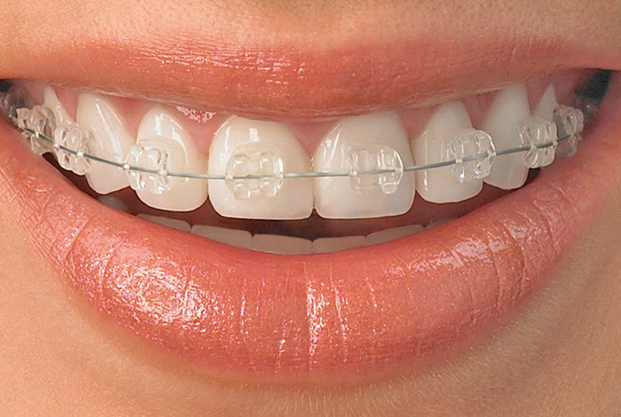 Braces Image